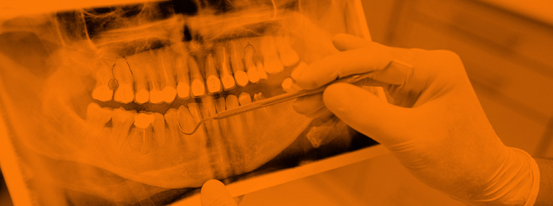 Fracaso en tratamiento de implantes dentales